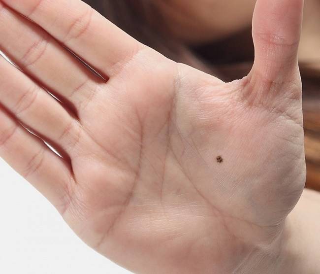 Exploring The Astrological Secrets Of Right-Hand Moles Palm Mole Astrology